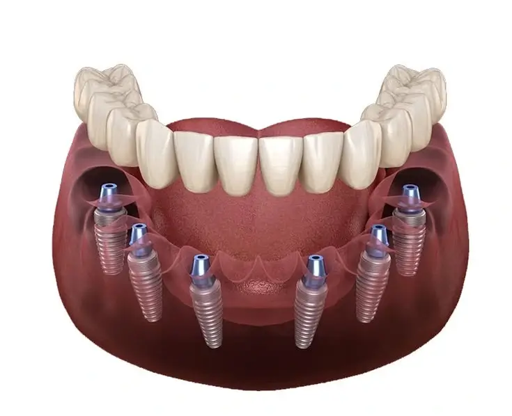 Multiple dental implants consultation at Buttercross Dental Practice