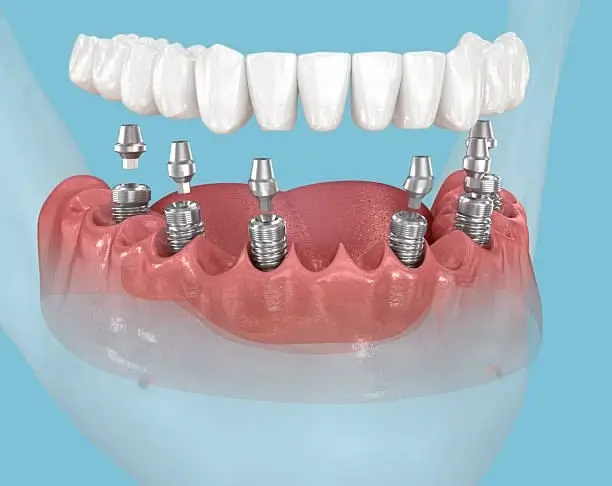 Assessing suitability for multiple dental implants