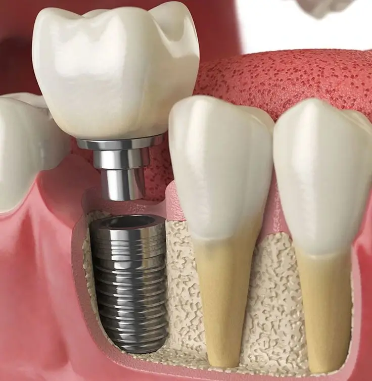Bone grafting for dental implants illustration