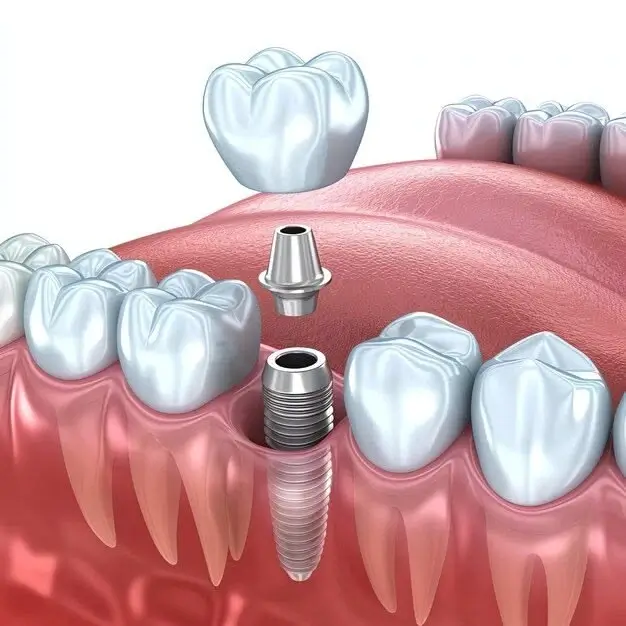 Confident smile after dental implant treatment