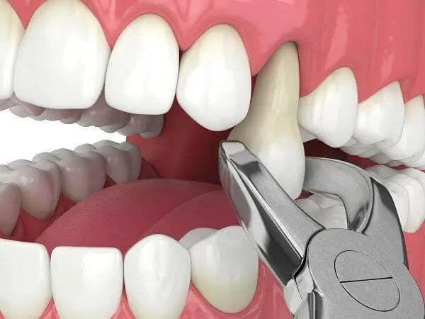 Tooth extractions at Buttercross Dental Practice