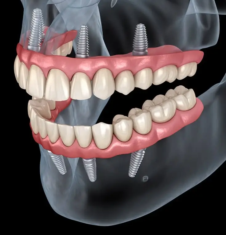 Caring for multiple dental implants long term