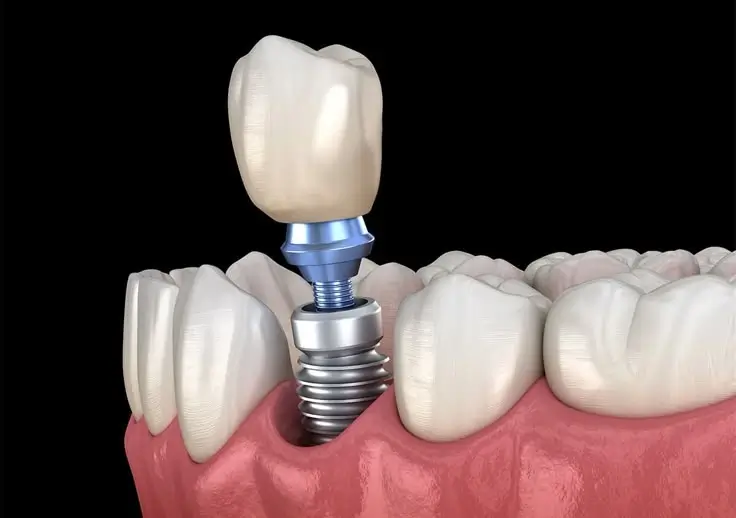 Natural looking dental implant crown detail