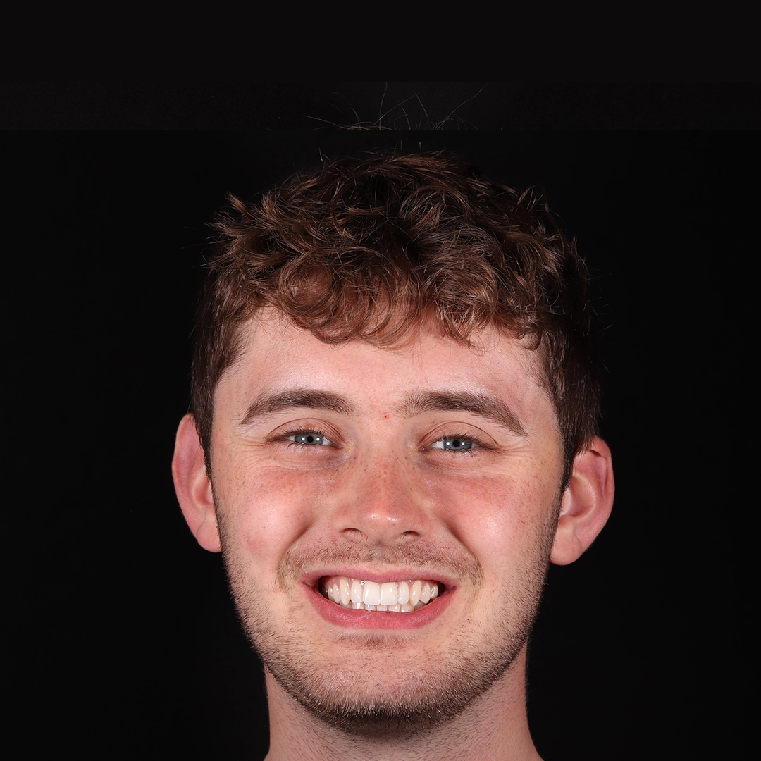 Invisalign results at Buttercross Dental Practice