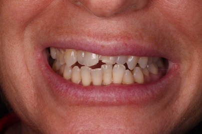 Before — Case A
