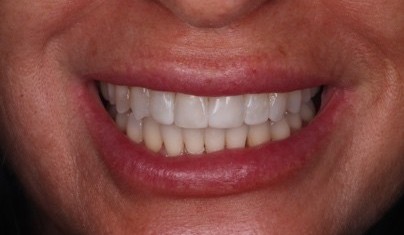 After — Case A