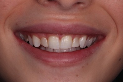 Before — Case B
