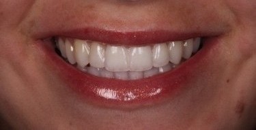After — Case C