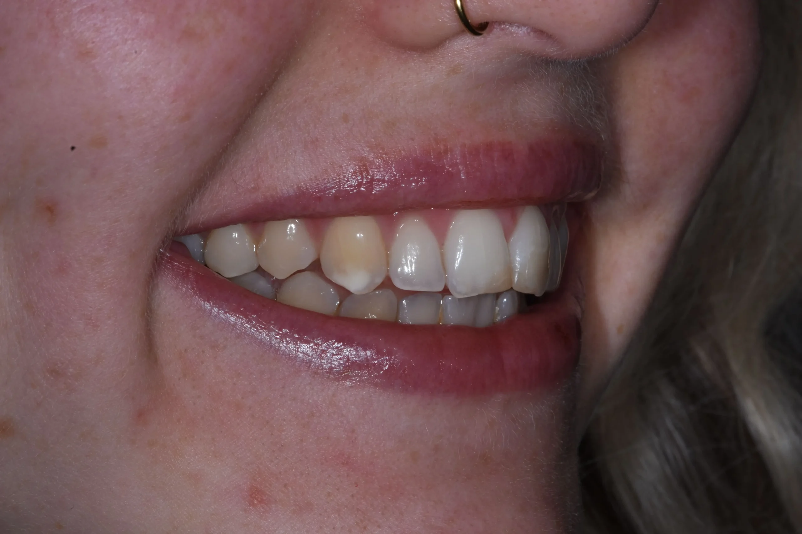 Before — Patient 2
