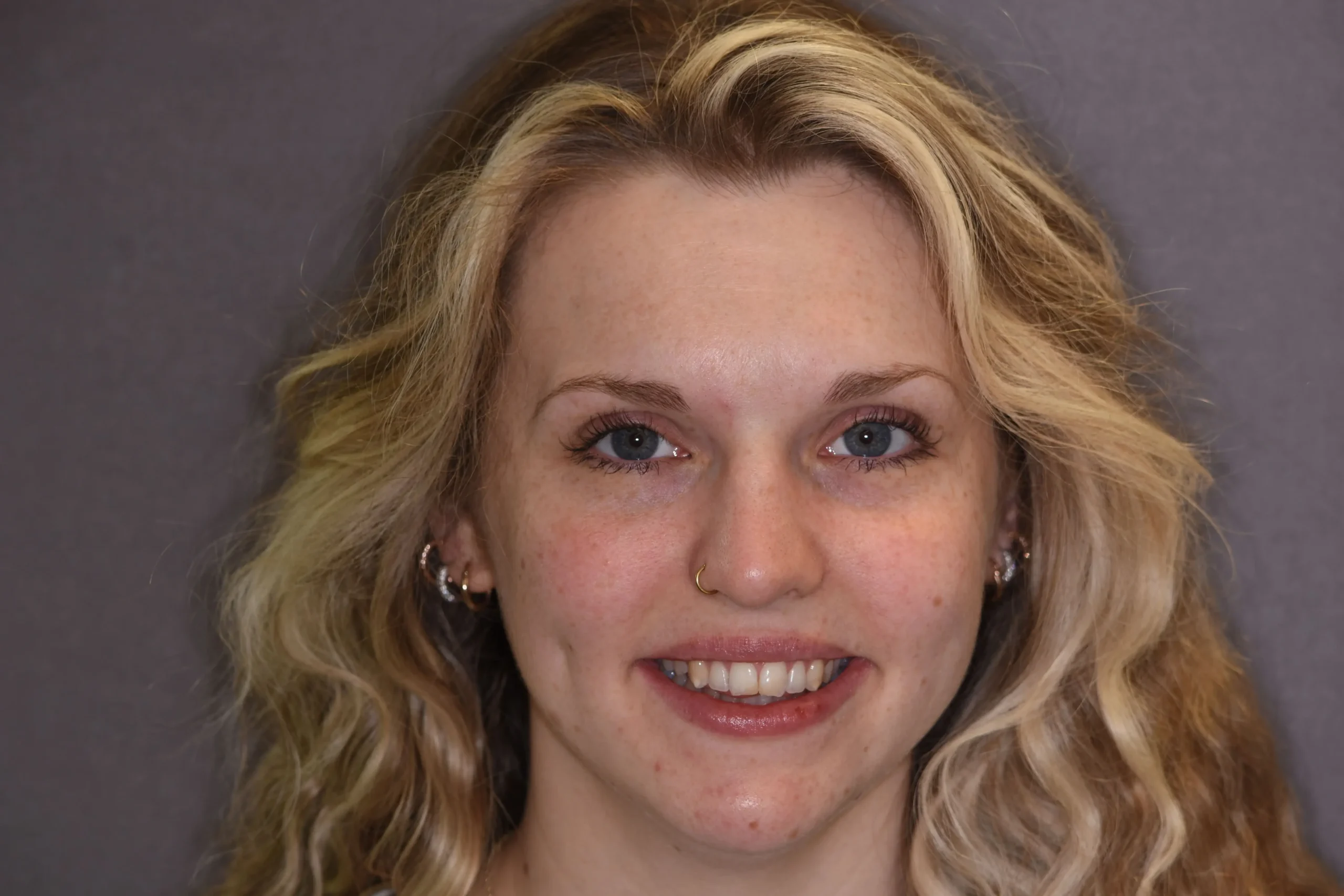 Smile makeover consultation