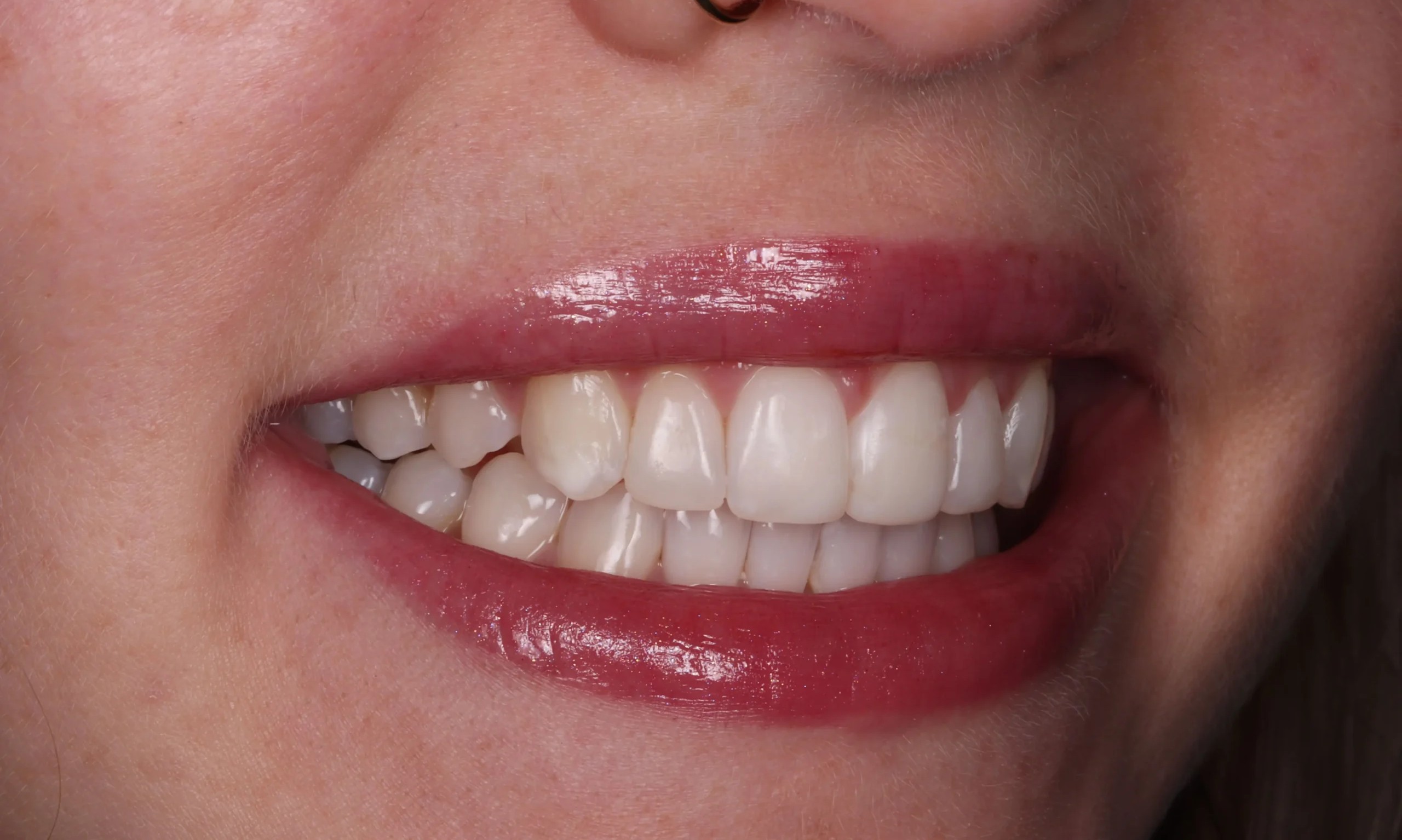 Porcelain veneers at Buttercross Dental Practice