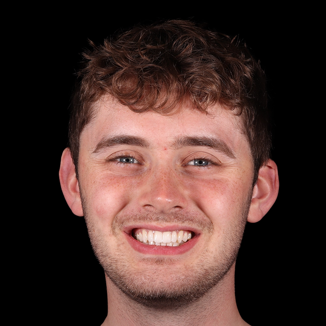Teeth whitening result at Buttercross Dental Practice